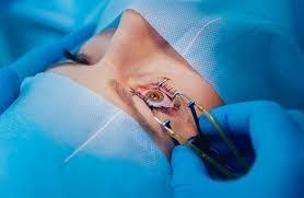 What is laser surgery?